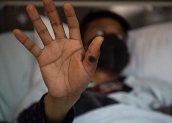 África registra más de 48.000 casos y 1.048 muertes por mpox en 19 países