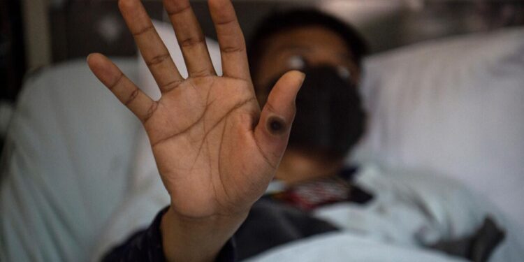 África registra más de 48.000 casos y 1.048 muertes por mpox en 19 países