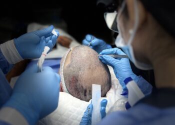 Spiro Hair Restoration Center revoluciona el trasplante capilar en Venezuela con tecnología de vanguardia