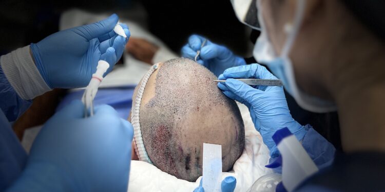 Spiro Hair Restoration Center revoluciona el trasplante capilar en Venezuela con tecnología de vanguardia