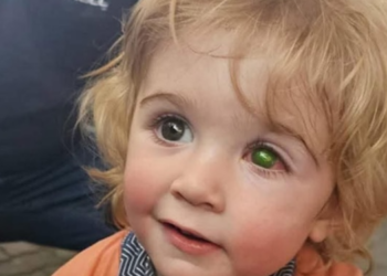 Un niño pierde la visión de un ojo tras contagiarse de herpes labial por un beso