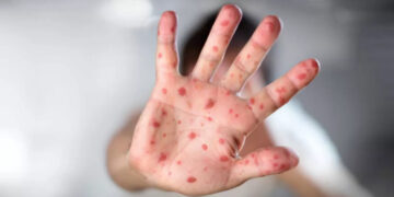 Diez países de las Américas reportan brotes de sarampión en 2025